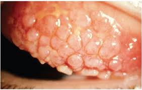 Image result for Vernal Conjunctivitis