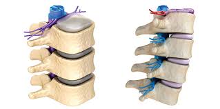 La estenosis aórtica es una lesión que se tolera bien durante años pero que, con el paso del tiempo, da lugar a la aparición de síntomas como el cansancio, el dolor torácico o la pérdida de conocimiento. Estenosis De Canal Lumbar Asssa