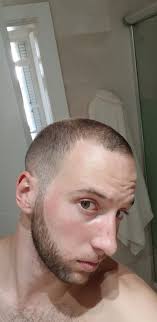 Why DHT doesn't cause hair loss