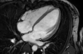 Diagnose einer myokarditis per ekg herzmuskelentzündung: Uke Centrum Fur Interdisziplinare Herzbildgebung Behandlungsangebot