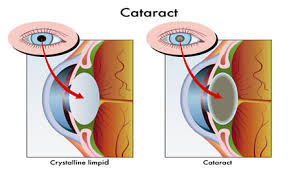 No, your vision generally doesn't deteriorate after cataract surgery unless other problems arise, such as macular degeneration or glaucoma. Cataract Surgery Why It S Done Risks What To Expect