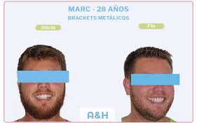 Marc, tratamiento con Brackets Metálicos