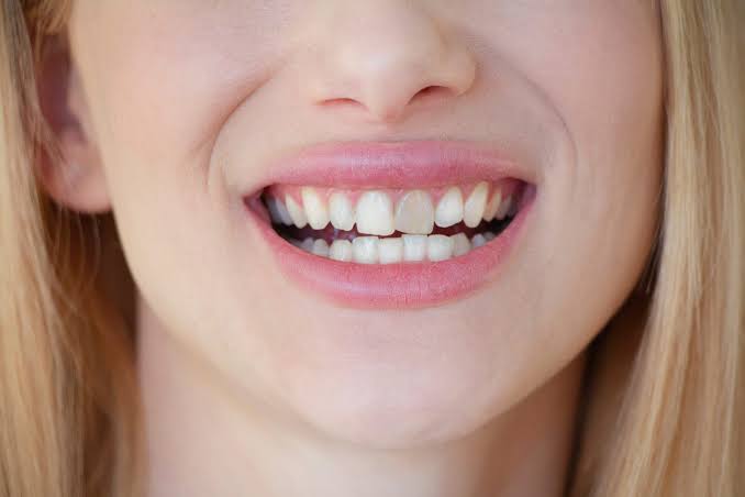 What Causes Tooth Discoloration? | Point Pleasant, NJ | Coastal Dental