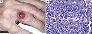 Image result for Merkel Cell Carcinoma