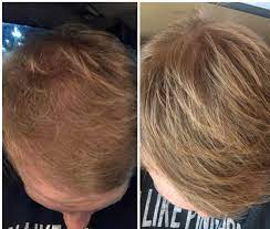 Finasteride is now available in a 1 mg dose for the treatment of male pattern baldness. 1 Year Of Finasteride Results Hairloss