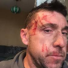 Even a professional with 25 years of experience can still be surprised.”  “This is the message Kevin Van Wesemael wants to share with everyone who  works in green spaces 🌳 An accident