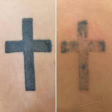 Avoid wearing tight clothing on the site until it heals. Pico Laser Tattoo Removal After 4 Sessions About 6 Months Between Each Session Photo On Left March 2019 Photo On Right December 2020 Tattooremoval