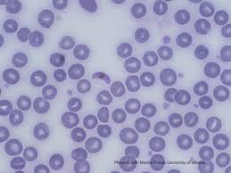 Falciparum life cycle, symptoms, diagnosis, treatment and prevention plasmodium falciparum is the plasmodium species responsible for 85 % of the malaria cases. Malaria A Laboratory Guide To Clinical Hematology