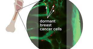 Cancer S Spread To Bone National Cancer Institute