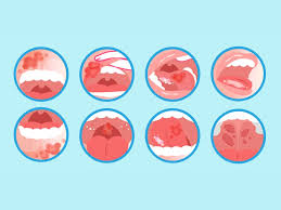 Image result for gum cancer symptoms