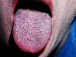 See full list on verywellhealth.com Hairy Tongue Dermnet Nz