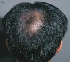 Topical minoxidil is the only approved treatment for fphl; Hair Loss Forum Nizoral Cream