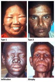 Community Eye Health Journal » Update