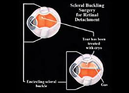 Check spelling or type a new query. Scleral Buckle Retina Repair Retinal Consultants Medical Group