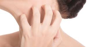 Eczema Rosacea Skin Care Common Skin Rashes Rosacea Acne Treatment