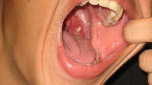 Diagnosis of acute tonsillitis is clinical, but sometimes it is hard to distinguish viral from bacterial infections. Holes In Tonsils Causes Sore Throat And More