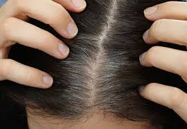 Dyeing your hair too often, especially if you are using bleach, can also lead to hair loss. Why Hair Turns Gray Health Essentials From Cleveland Clinic