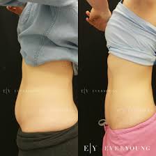 coolsculpting the reviews are in