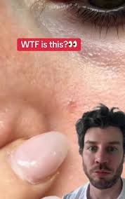 Image result for skin cancer on nose pimple