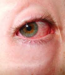 Image result for Eye Pain without Redness