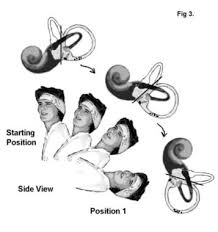 Image result for Canalith Repositioning Procedure