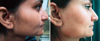 Here and there where they are not wanted. Laser Hair Removal For Black Or Dark Skin In Philadelphia Pa
