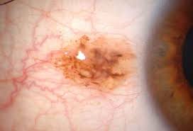 Image result for nevus sclerae