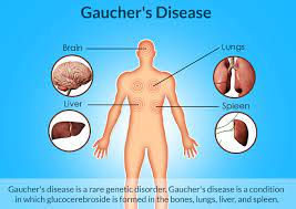 Health Tips Harmful Effects Of Gaucher S Disease