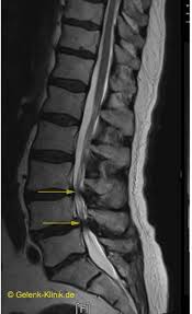 Spinalkanalstenose Verengung Des Ruckenmarks Der Wirbelsaule Gelenk Klinik De