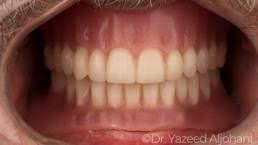 قبل و بعد أسنان صور العلاج تركيبات و زراعة و تجميل الأسنان عيادة أسنان دكتور يزيد الجهني