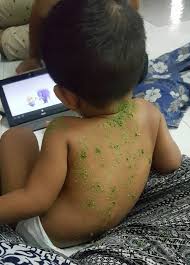 Orang dewasa dapat mengurangi kemungkinan terkena penyakit ini dengan mengurangi faktor risiko yang ada. Chicken Pox Kering Dalam 7 Hari Ibu Ini Kongsi Tips Cara Penjagaannya