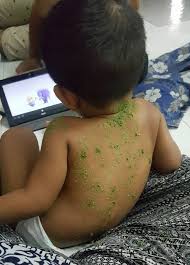 Ohh., terhampar pemandangan indah dengan bau yang khas, lubang yang sempit, lebih sempit dari yang di depandan sekitarnya. Chicken Pox Kering Dalam 7 Hari Ibu Ini Kongsi Tips Cara Penjagaannya