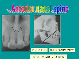 The anterior nasal spine, or anterior nasal spine of maxilla, is a bony projection in the skull that serves as a cephalometric landmark. Ppt Normal Anatomical Radiographic Landmarks Powerpoint Presentation Id 3477892