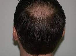 Constantly brushing and holding hair tightly can cause some hair loss. Tucson Hair Replacement And Scottsdale Hair Transplant Clinic In Arizona The Renowned Dr Keene Over 20 Yrs In Hair Loss Private Consultation 520 290 5555