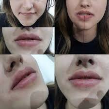 Dudak Dolgusu Nasil Yapilir Uygulama Sekli Ve Cesitleri Antalya Juvederm Dysport