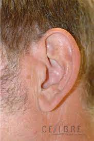 If you're ready for a more permanent solution, you may want to consider laser ear hair removal. Before And After Laser Hair Removal For Removing Ear Hairs 3