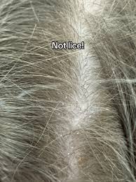 Image result for lice vs dandruff
