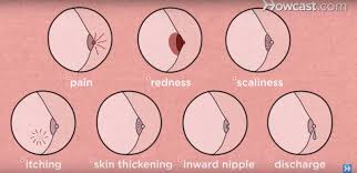 Common sites for breast cancer to spread are the brain, lung, liver and/or bones. If You Notice Any Of These 6 Signs Don T Ignore Them They Could Be Early Symptoms Of Breast Cancer