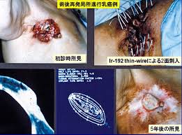 市民のためのがん治療の会
