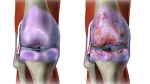 Osteoarthritis Symptoms Treatments And Causes