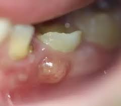 Blood blister inside cheek pictures. I Got A Blister On My Lower Lip Inside My Mouth I Recently Had A Root Canal Treatment Done Is This A Serious Problem Will It Go Away On Its Own