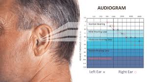 We did not find results for: The Audiogram How To Read It