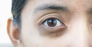 Red eyes tattoo ideas scary best tattoos eyes tattoos and body art red. Eye Bags Vs Under Eye Circles Prive Clinic Singapore