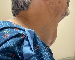 Image result for Goiter