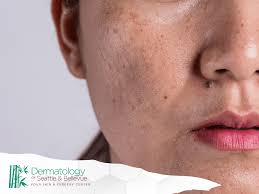 Image result for Melasma