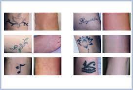 Cork, cork, business reviews, consumer complaints and ratings for tattoo services in cork. Laser Tattoo Removal The Grove Skin Laser Clinic Swansea