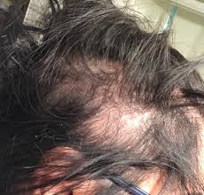 Birth control pills can cause hair loss due to their effect on a person's hormones. Feeling Insecure After The Nexplanon Implant Glow Community