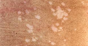 Check spelling or type a new query. Tinea Versicolor