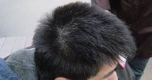 Produk untuk hilangkan jerawat terbaik kualiti t20 dengan bajet b40 malaysia skincare. 8 Petua Hilangkan Kelemumur Yang Teruk Di Kepala