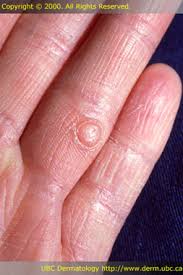 Image result for Papule